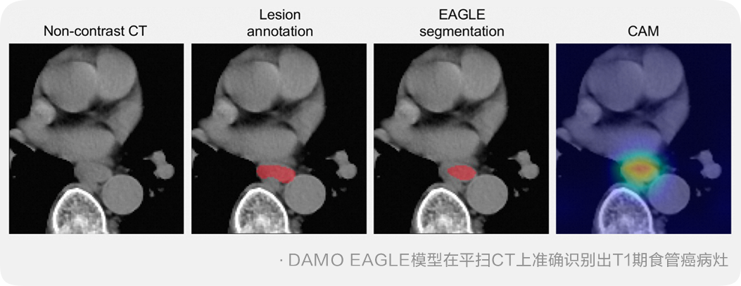 阿里达摩院发布食管癌 AI 模型,“不插管”发现早期和癌前病变 图片